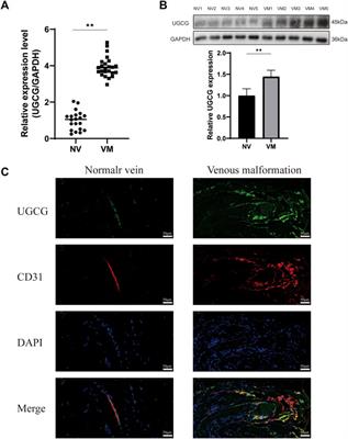 Role of UDP-glucose ceramide glucosyltransferase in venous malformation